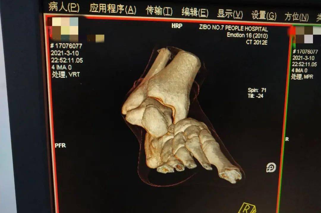 踢足球不慎扭傷腳踝畸形腫脹病情嚴重緊急求醫