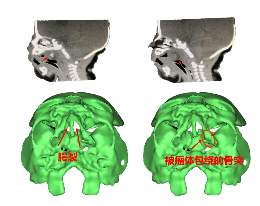 口腔颌面外科根据ct扫描结果,采用数字化技术重建颌骨三维形态并进行