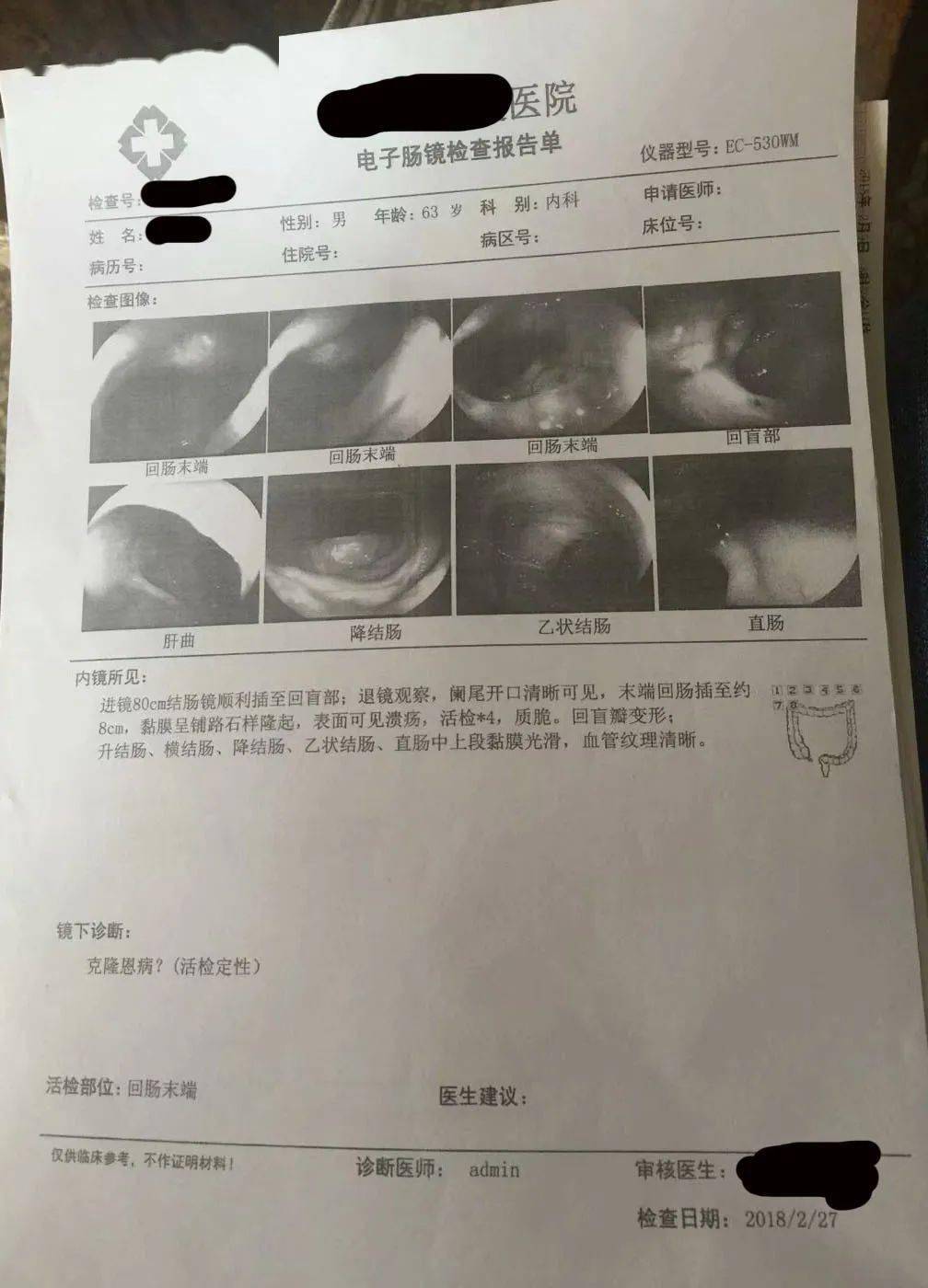 肠镜报告诊断结果为"克罗恩病?