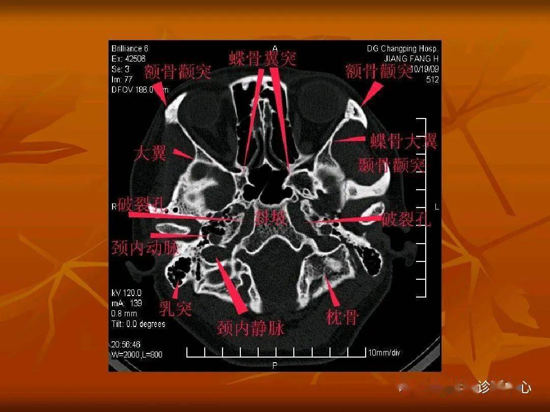 颅底骨断层解剖图ct图片