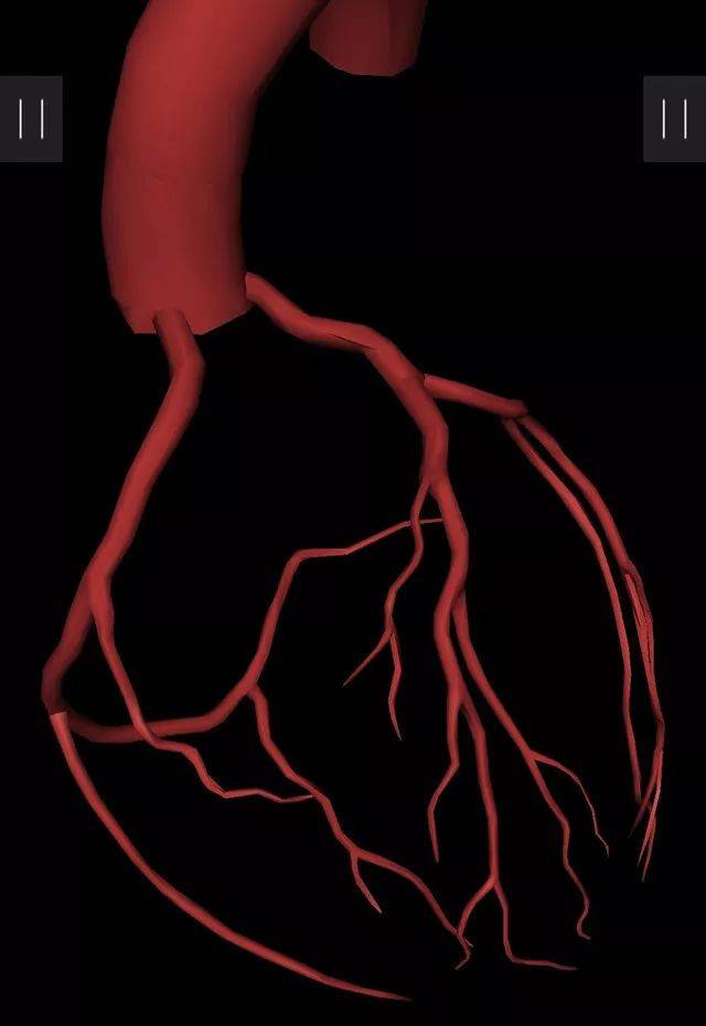 高清3d图像轻松理解冠脉造影体位