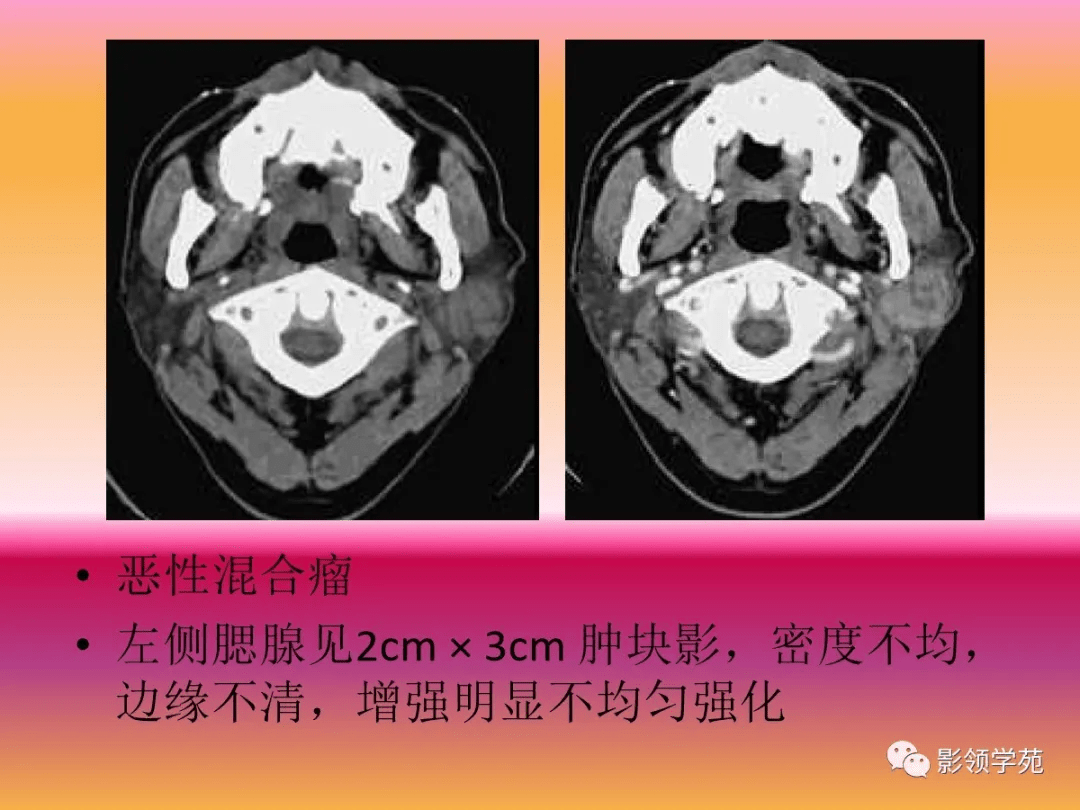 囊腫:分為瀦留性和先天性兩大類,先天性囊腫分皮樣囊腫和鰓裂囊腫兩大