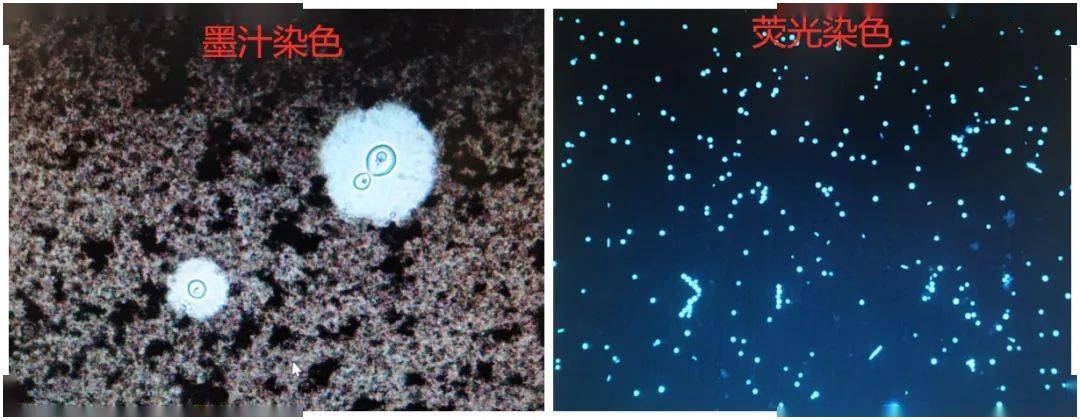 新生隐球菌墨汁染色图片