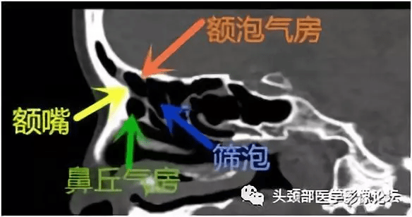 影像解剖額篩氣房與鉤突附著部精細解剖