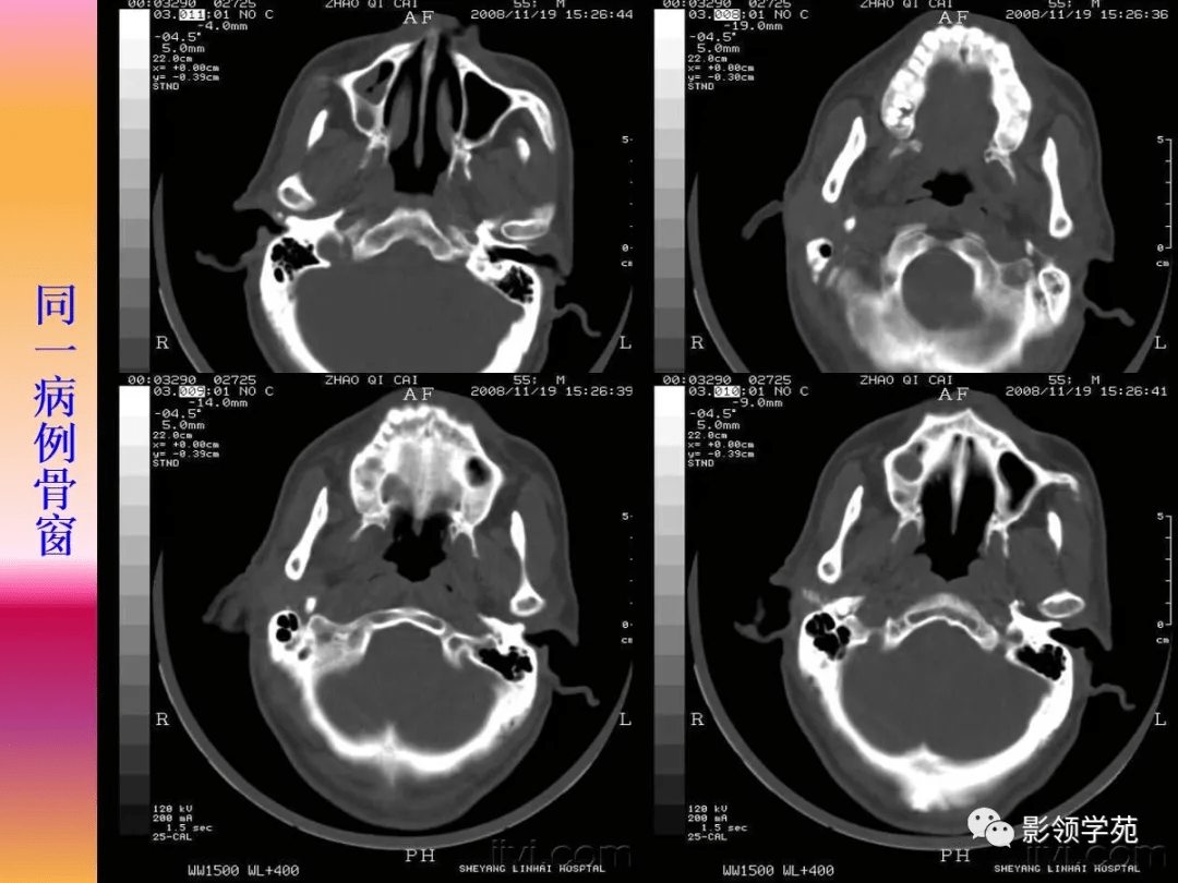 傳染病 | 流行性腮腺炎 面頰腫脹感染病毒 | 健康百科