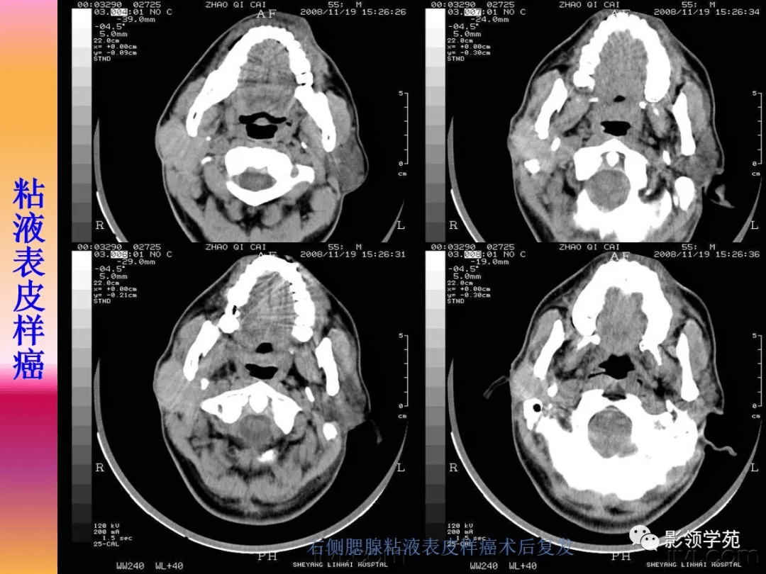 腮腺疾病的ct诊断与鉴别诊断