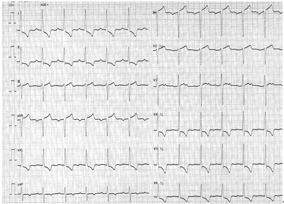 出现顺钟向转位,室间隔除极方向变为由右向左,造成Ⅰ,avl导联出现qs波