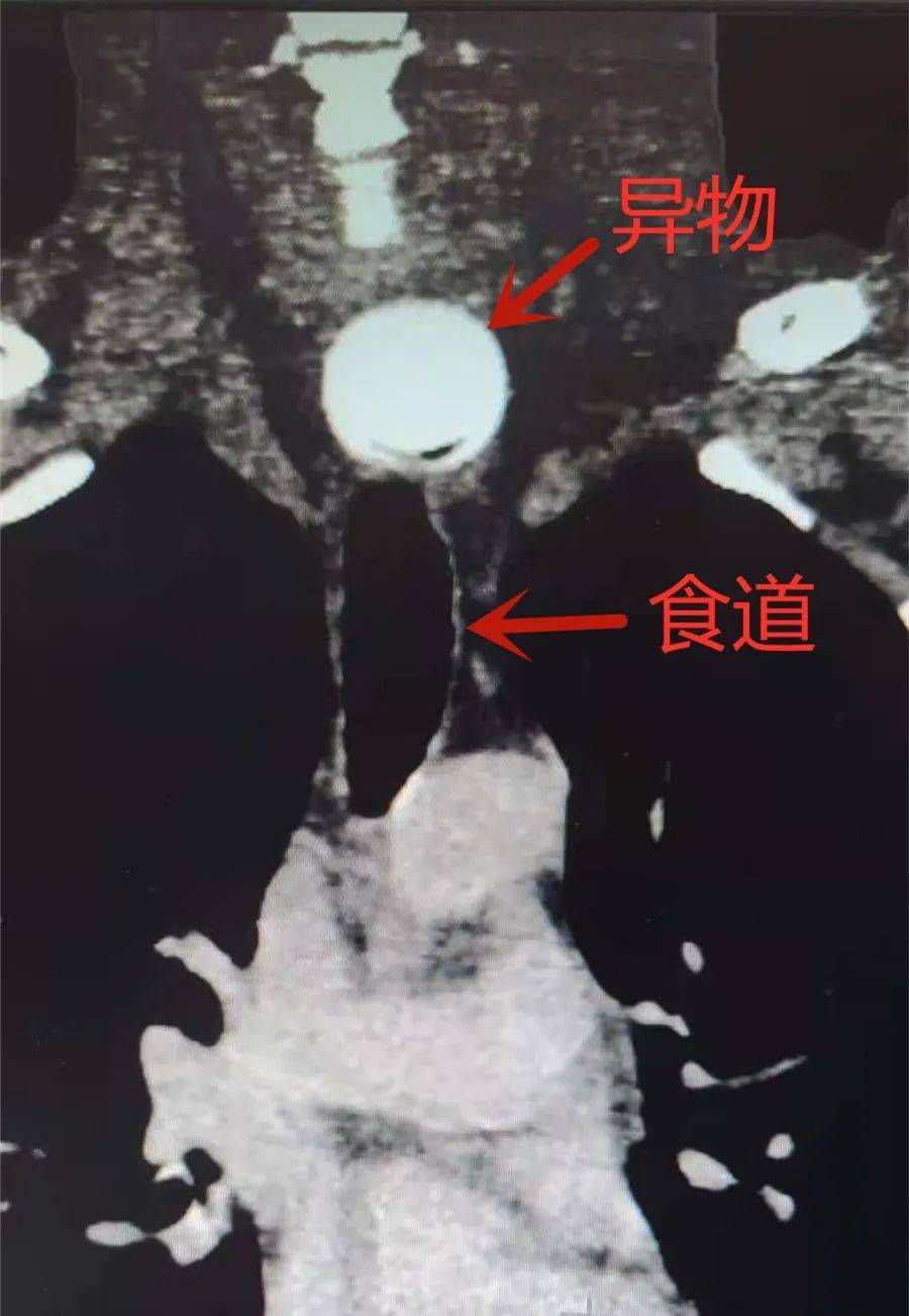 "車"卡在食管上段入口处医院接诊后经ct检查,发现有一直径约3cm,厚度