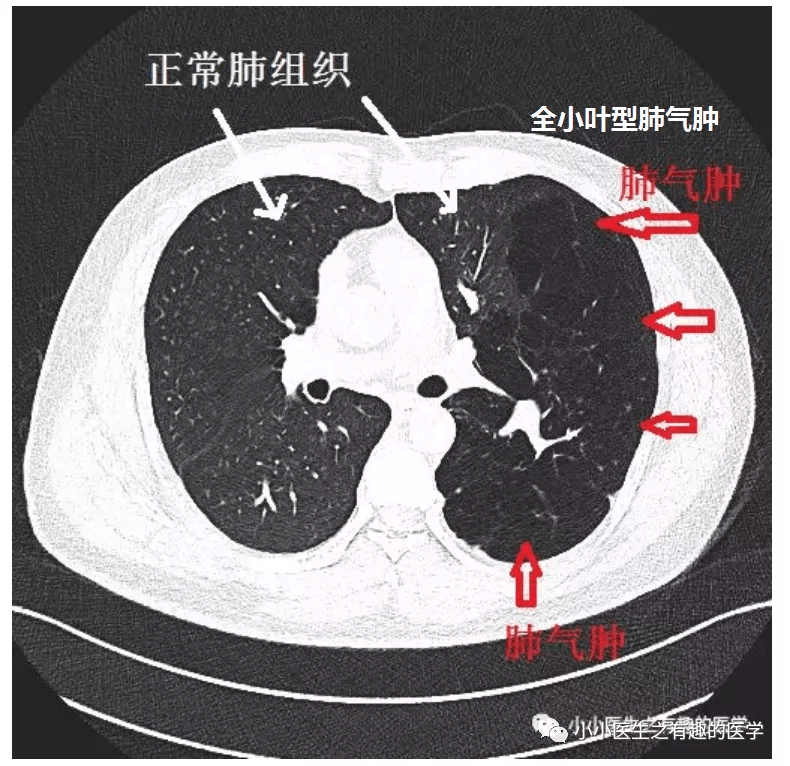 正常肺ct片图片图解图片
