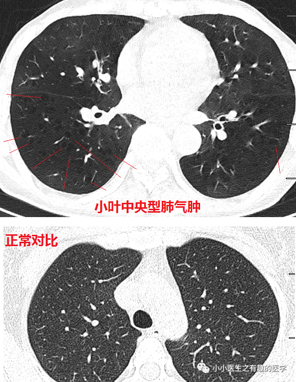 正常肺CT图片与病变CT图片