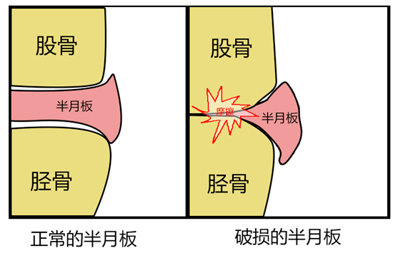 半月板损伤不用怕 中医应对有妙招 膝关节