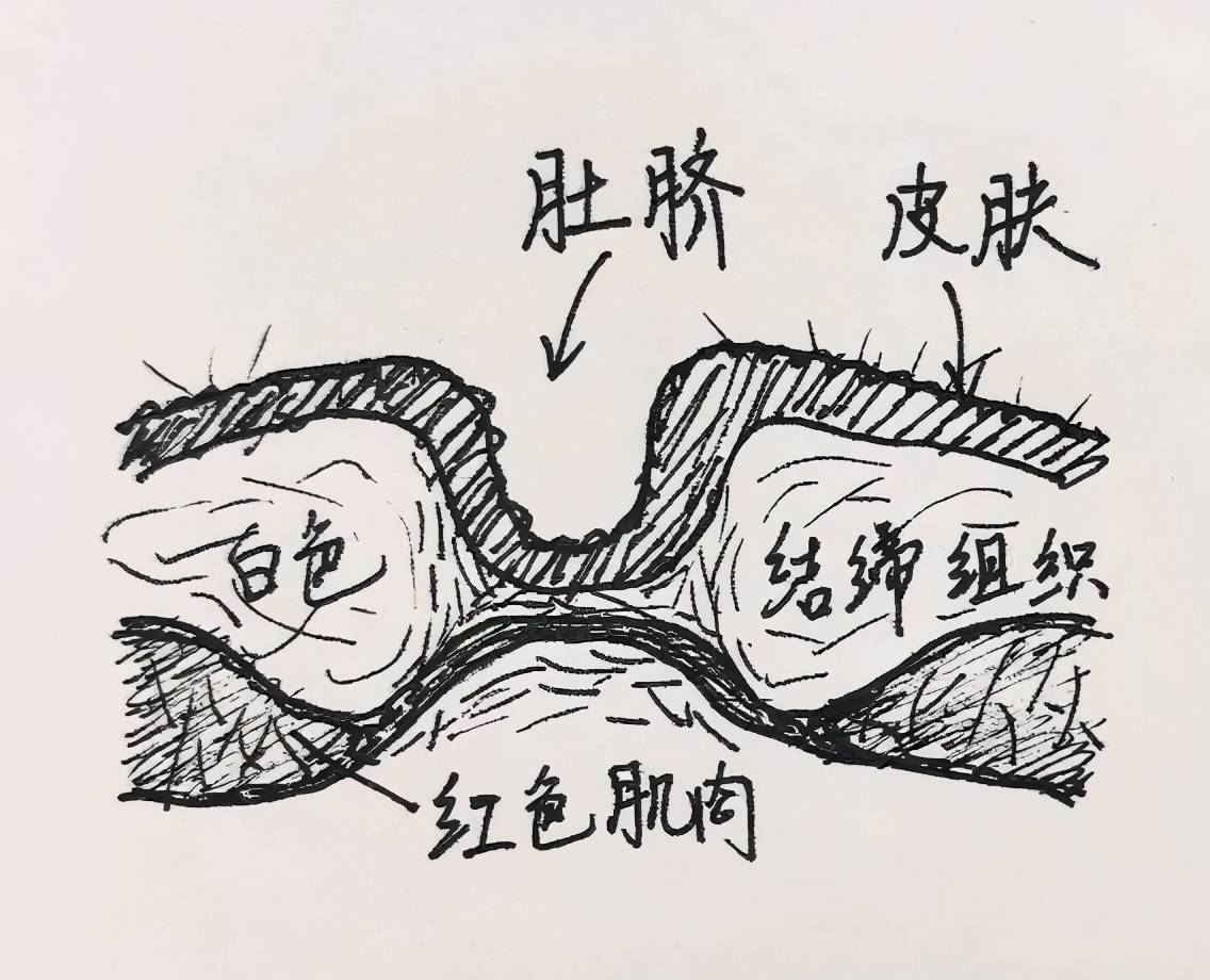 当心宝宝肚脐鼓的吓人超过4岁可能要手术