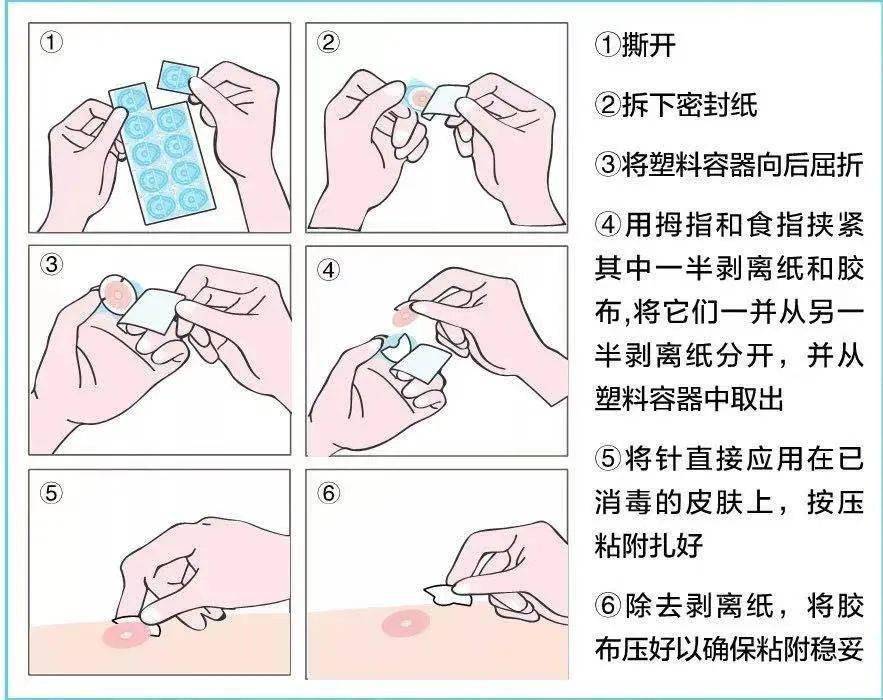 日本清铃揿针图片