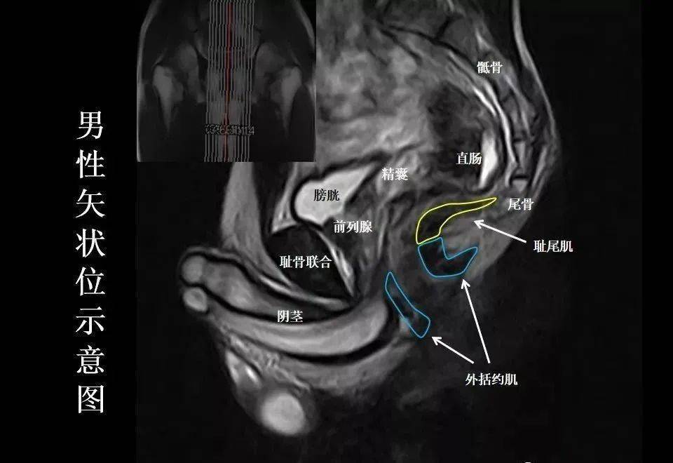 子宫核磁解剖图图片
