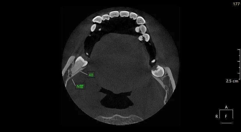 ct示:48近中阻生,双根,根尖紧邻下颌神经管上壁,38埋伏阻生,双根,根尖