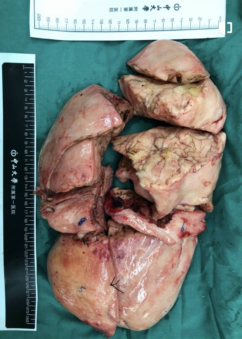 巨大肿瘤挤占整个左胸腔 19岁女子在中山一院保肺摘瘤