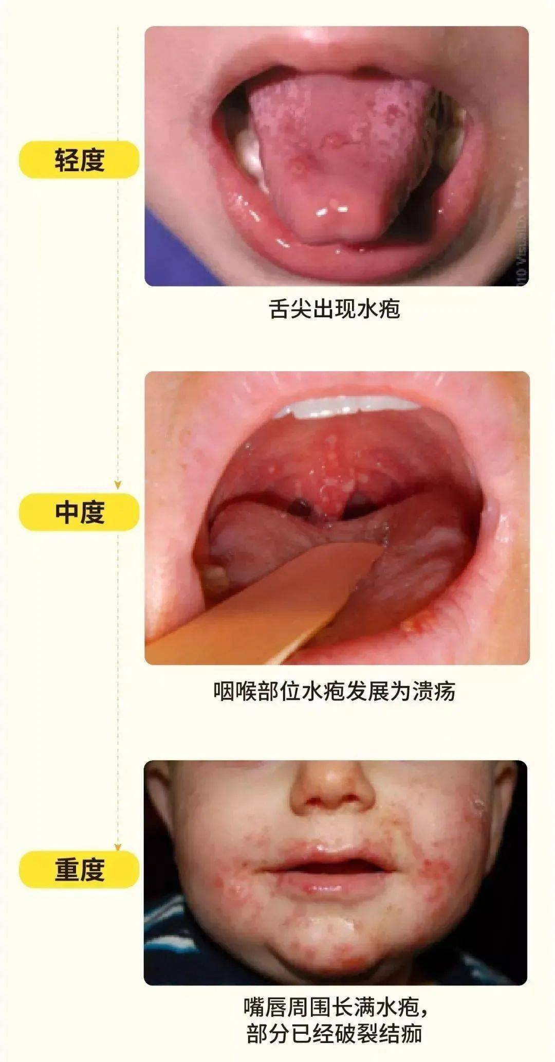 疱疹用什么中药好 92859c56375845f49fe42e260cc1bd19.jpeg