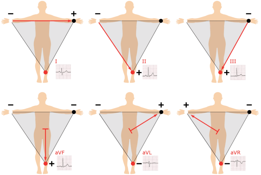 如何一眼識別心電圖導聯接反