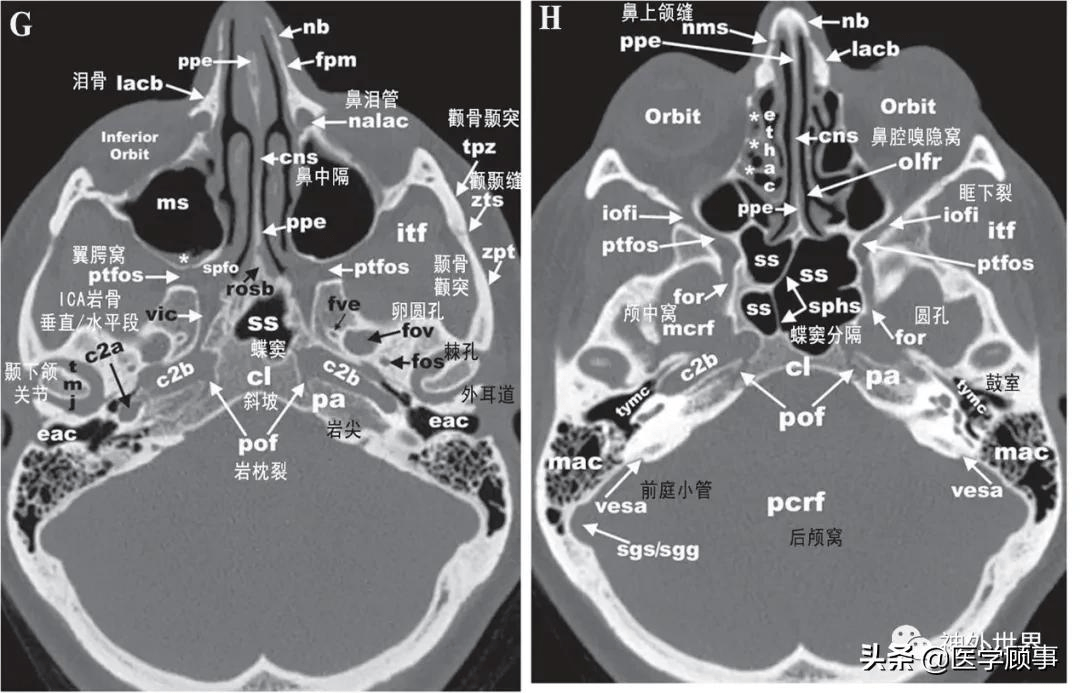 2颅底ct骨窗影像解剖图2:颅骨侧面观(上),前面观(中)和后面观(下)图1