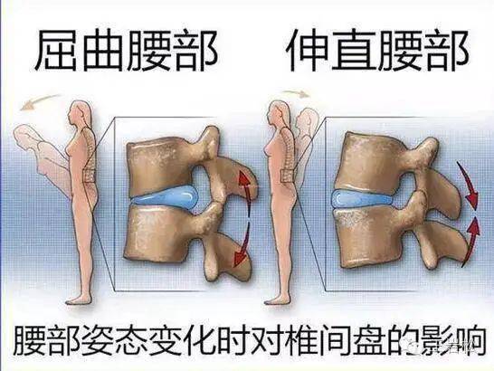 带您了解"腰椎间盘突出"与"腰椎间盘突出症"