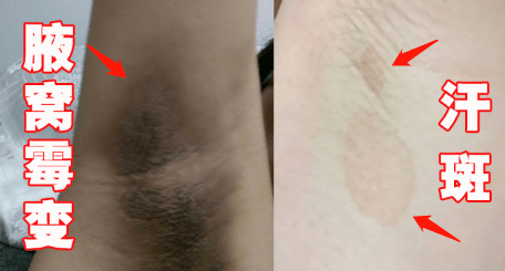 经常被别人误以为是不洗澡,不讲卫生就会变成腋窝霉变,汗斑等更难缠的