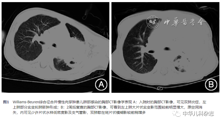 【病例报告】williams-beuren综合征合并慢性肉芽肿病一例
