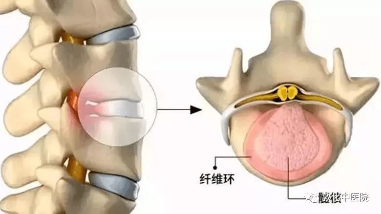 腰椎间盘突出症与梨状肌综合征的鉴别 坐骨神经