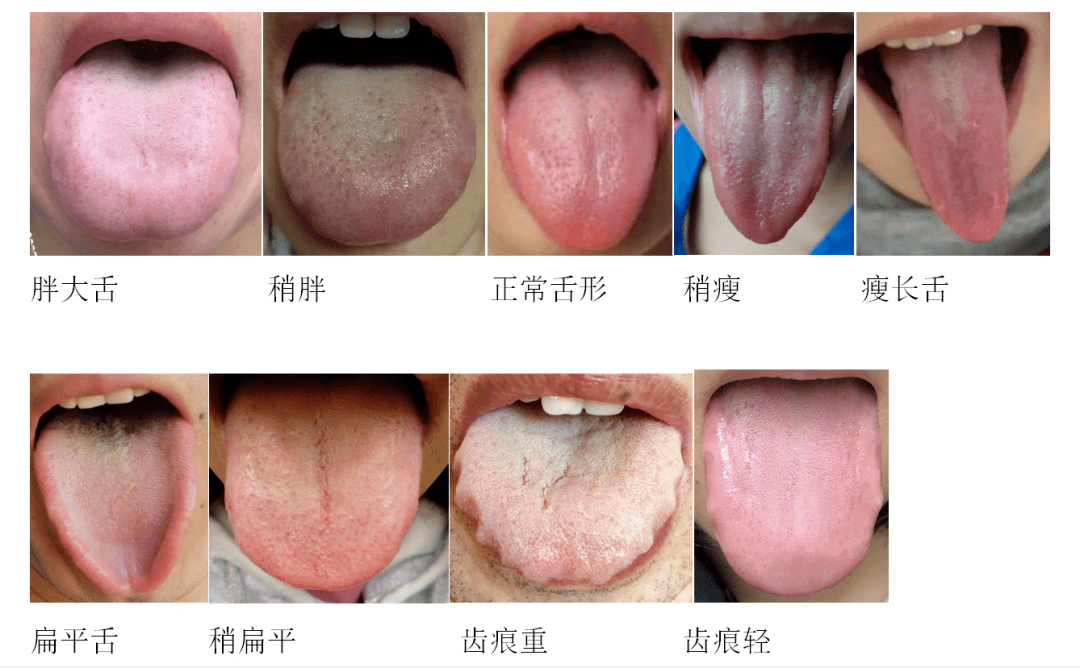 人的舌头有几种形状图图片