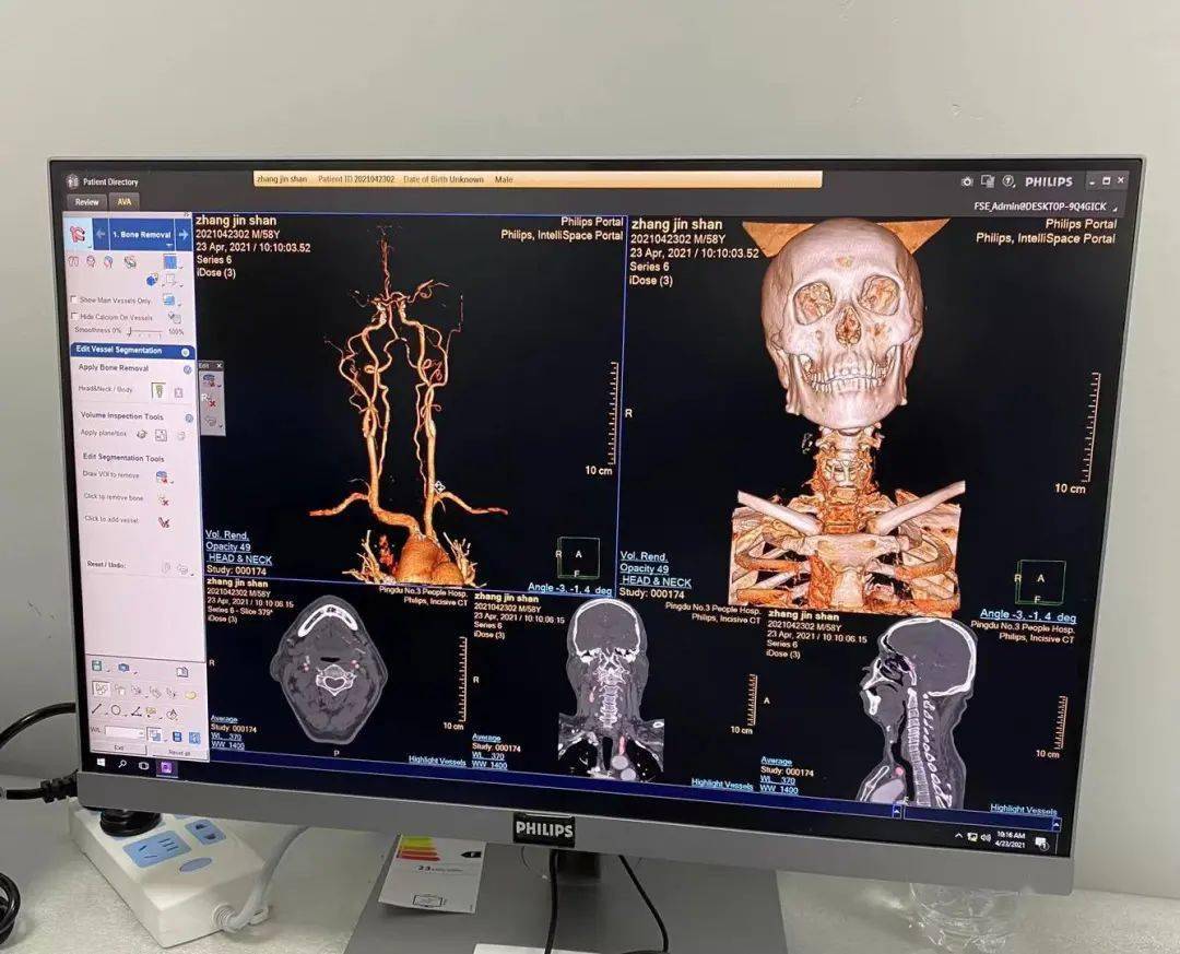 平度市第三人民医院飞利浦64排128层incisive极光ct投入