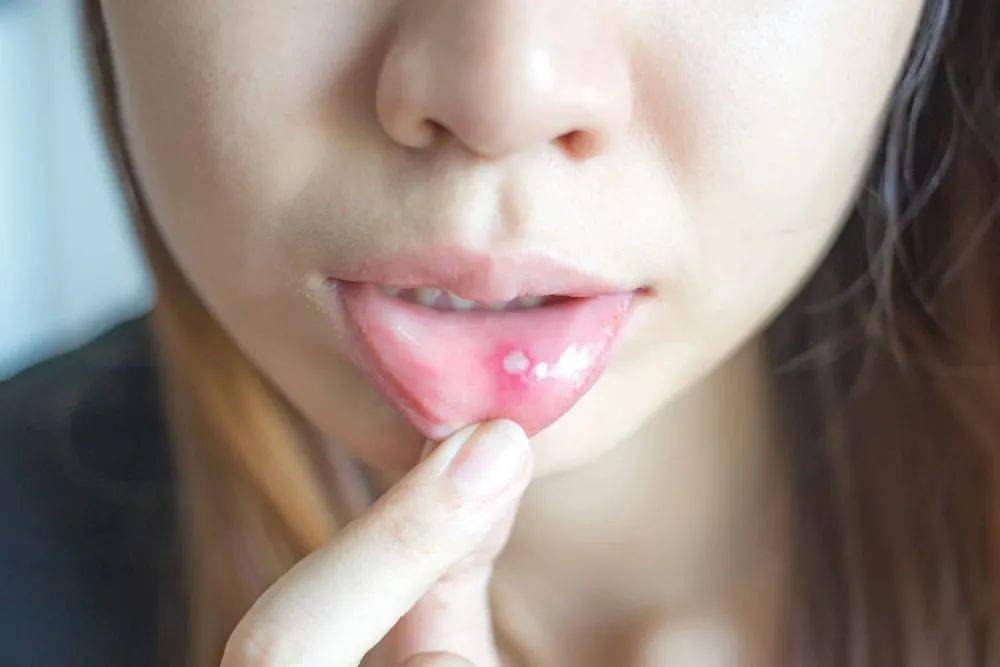 口腔溃疡久不愈竟被查出癌这些信号别忽视