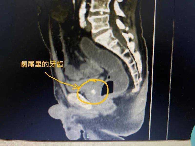 牙齿吞到肚子里怎么办