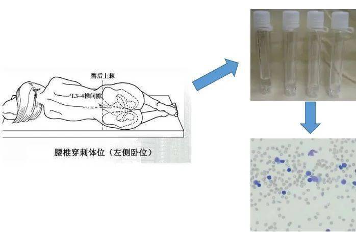 腰椎穿刺术获取脑脊液标本,用于分析是否为感染?何种病原微生物?