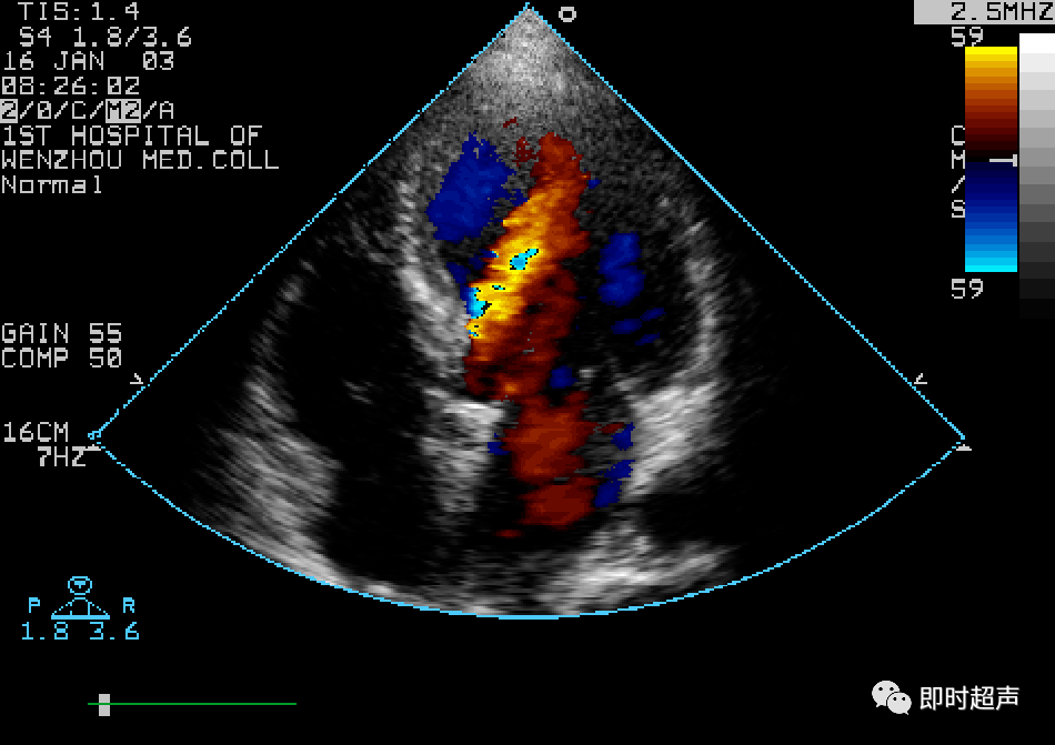 心臟瓣膜病超聲診斷_二尖瓣