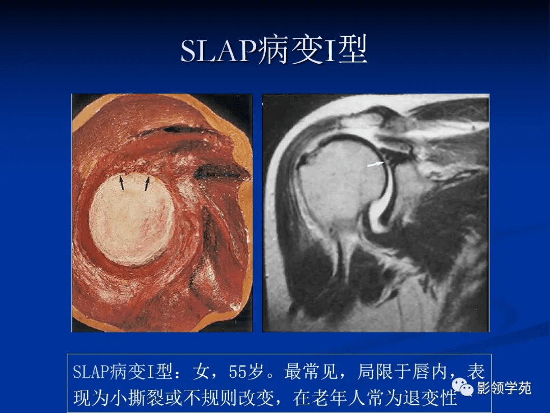 肩关节盂唇损伤的mri诊断