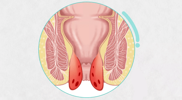疾病科普丨發生內痔脫出時你最應該做的幾件事