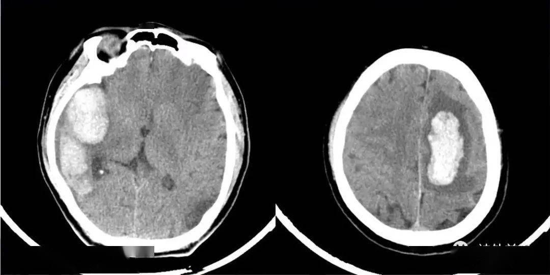 睿米特约 | 机器人辅助脑出血穿刺引流10例 血肿排空有哪些技巧