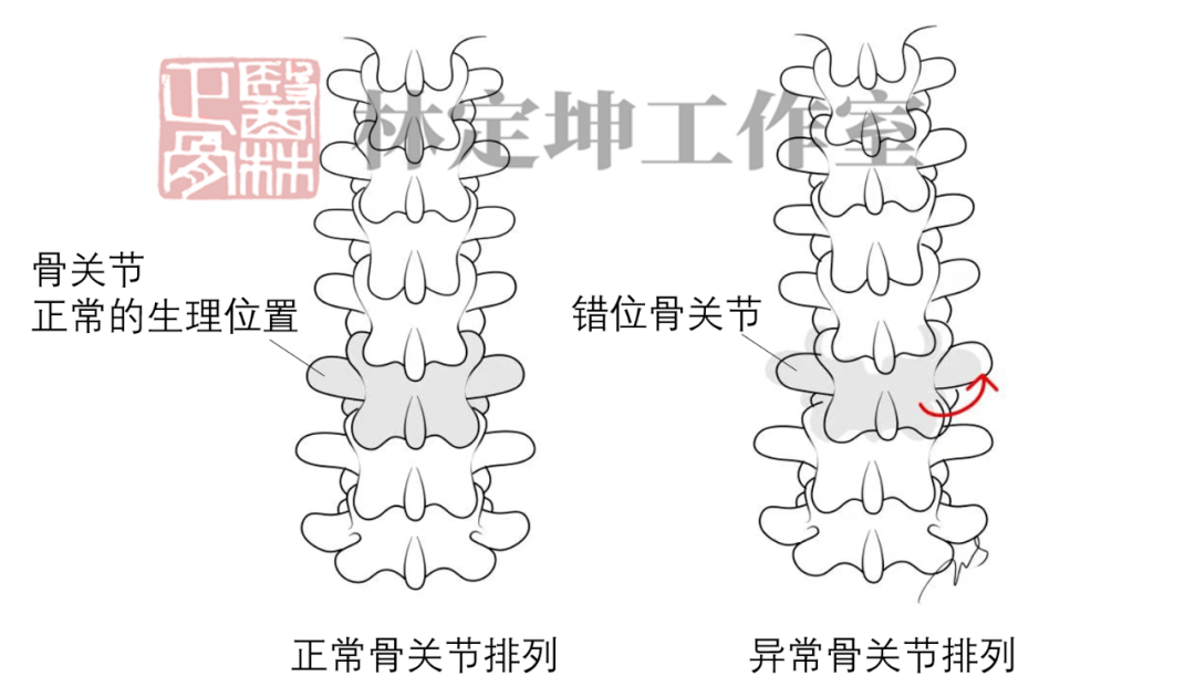 關節錯位勿忽視!_腰椎