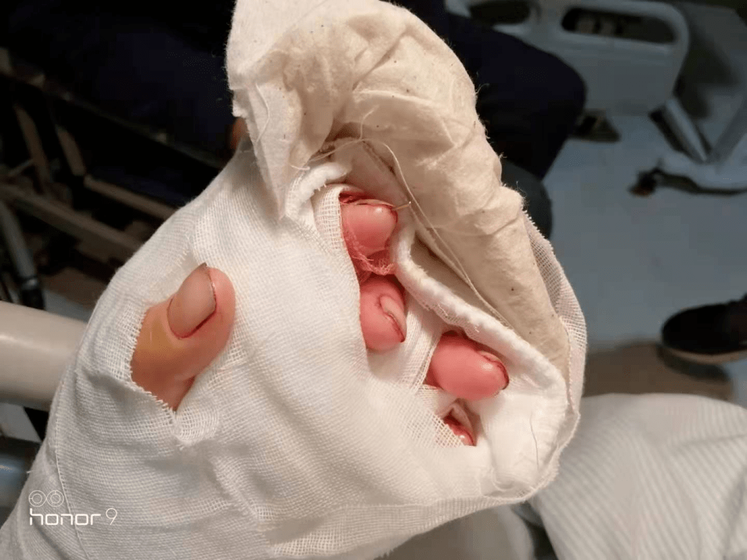 突发慈溪一女子工作时4根手指被机器锯断好在