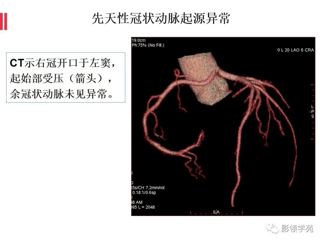 如何分析冠状动脉cta