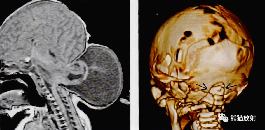 (左)一位产前诊断为脑膨出的新生儿,矢状位t1wi显示巨大的脑膜脑膨出