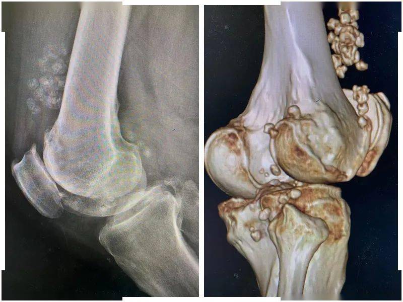 一窝"小老鼠"折磨50岁大叔6年,整整36"只"!_膝关节