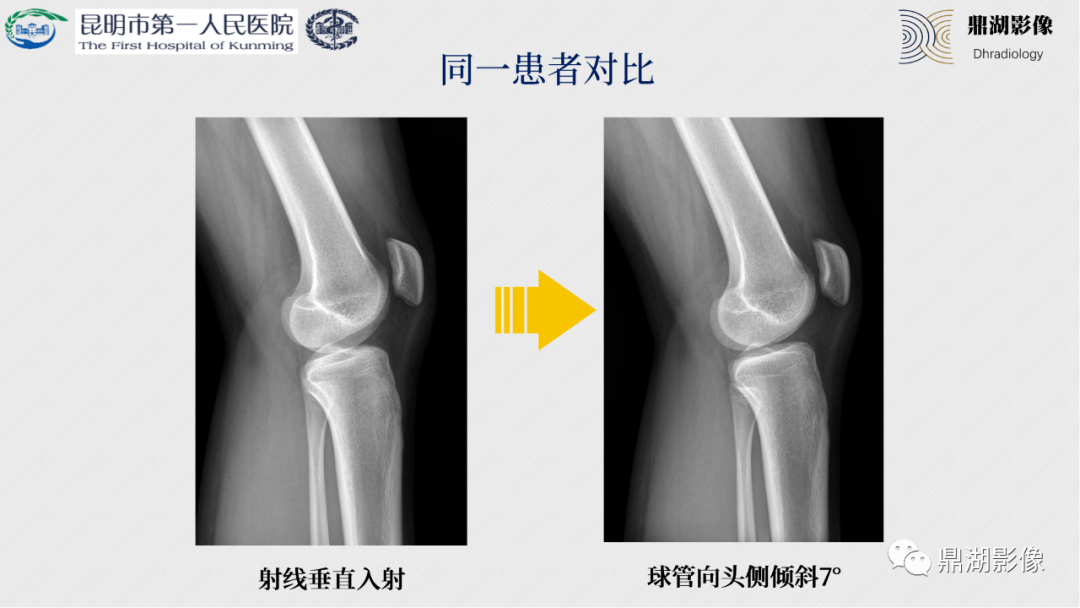 拍x光片要脱内衣_正常的颈椎x光片图(3)