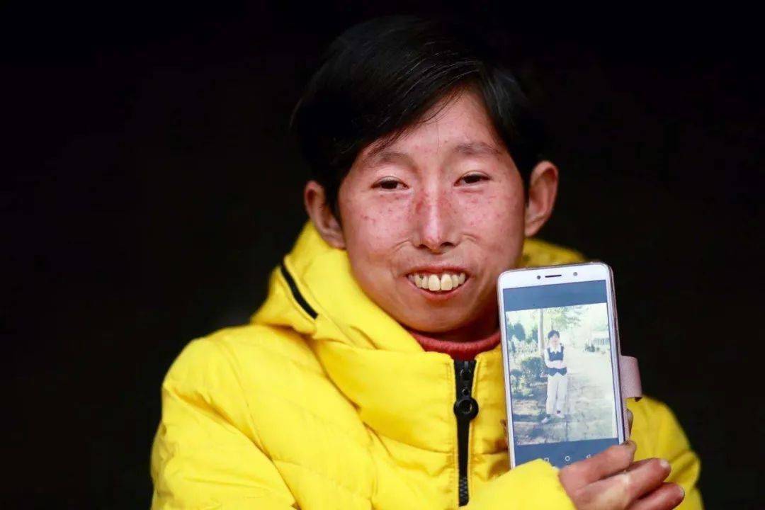 皮肤僵硬,不能微笑,干咳数十年.这种病太痛苦了!