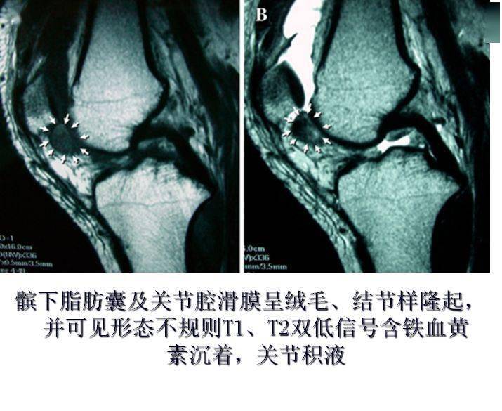 結節樣隆起,並可見形態不規則t1,t2雙低信號含鐵血黃素沉著,關節積液