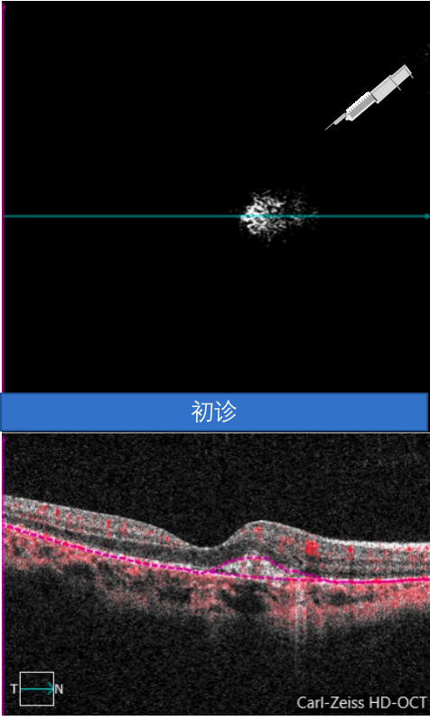 右眼oct扫清扫描可见椭圆体带,光感受器外节,交叉区及rpe光反射不规则