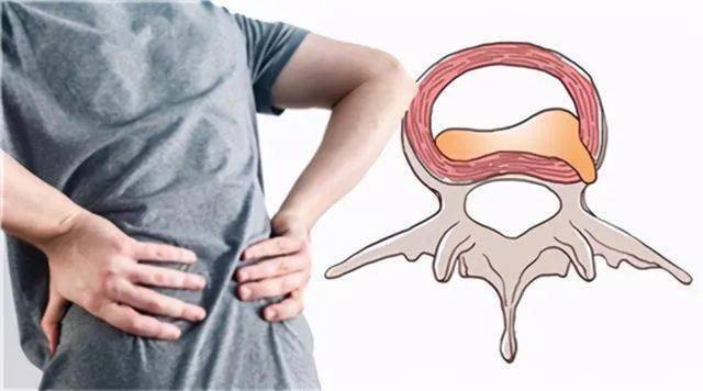 腰间盘突出哪里疼图片图片