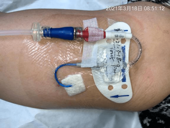 PICC 并发穿刺点渗血,选择止血敷料有何讲究?_患者