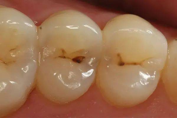 牙医却说:"这时病变已经破坏到牙本质浅层了,  牙齿已经有龋洞形成,对