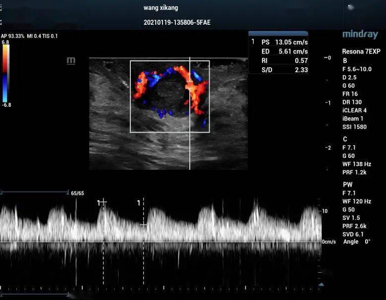明顯血流信號,周邊可見環狀血流信號圖 1 左乳頭內見一不均質回聲結節