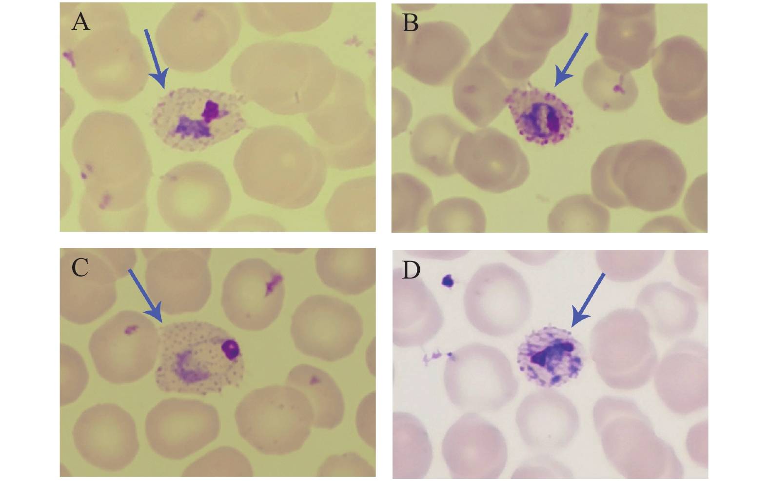 中疾控论文:广东首例疟疾新冠合并病例提示新冠或致疟疾复发_疟原虫
